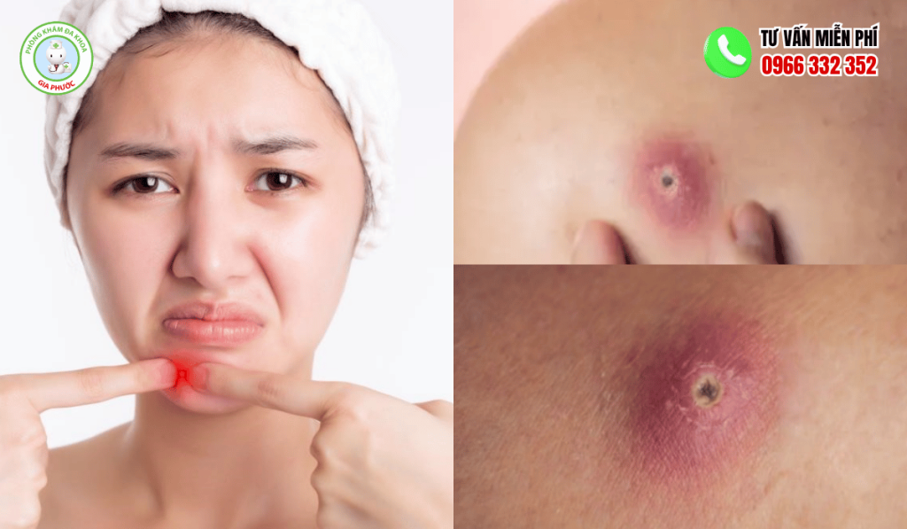 Hình ảnh mụn đinh râu