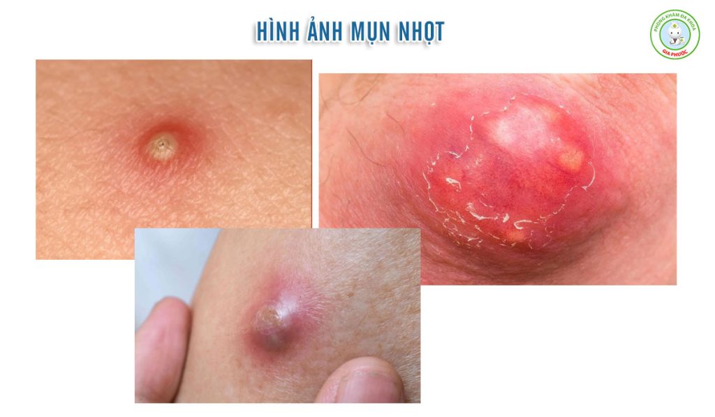 Mụn Nhọt Ở Mông Sưng To Đau Nhức: Nguyên Nhân, Dấu Hiệu Nguy Hiểm & Cách Xử Lý Chuẩn Y Khoa 2 Hình ảnh mụn nhọt ở mông sưng to đau nhức