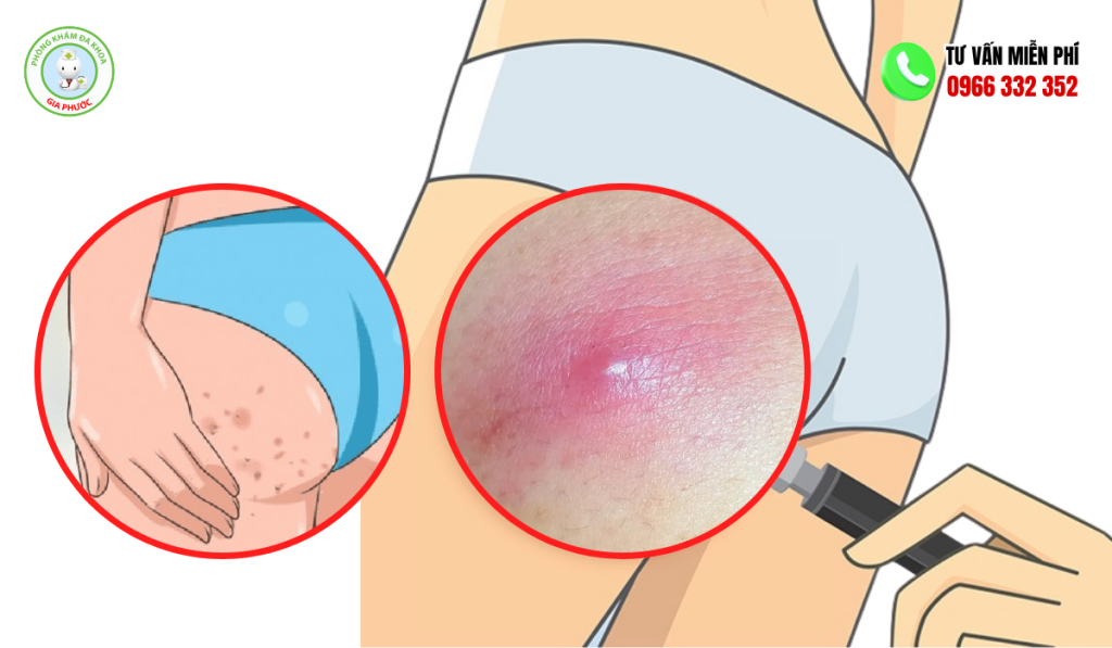 Hình Ảnh Mụn Nhọt Ở Mông Chi Tiết Và Cách Điều Trị Hiệu Quả 1 Hình ảnh mụn nhọt ở mông