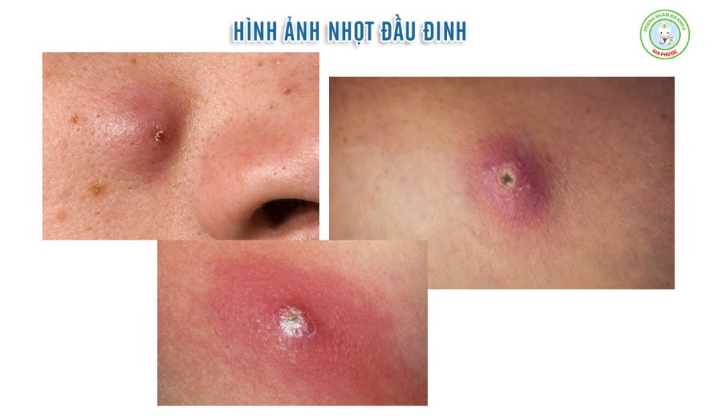 Hình ảnh nhọt đầu đinh