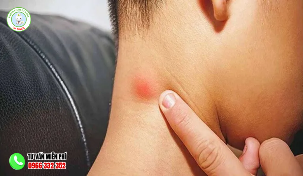 Hình ảnh nổi cục sau gáy không đau