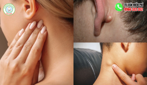 Hình ảnh nổi hạch sau tai