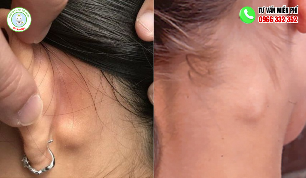 Hình ảnh nổi hạch sau tai
