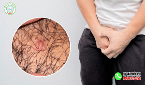 Hình ảnh nổi mụn ở vùng kín nam