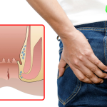 Hình Ảnh Bệnh Nứt Kẽ Hậu Môn Qua Từng Giai Đoạn 7 Hình ảnh nứt kẽ hậu môn
