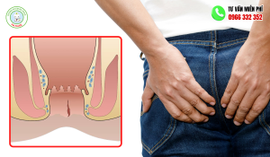 Hình ảnh nứt kẽ hậu môn