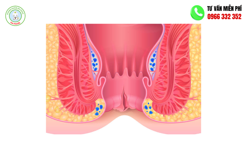 Nứt Kẻ Hậu Môn: Hình Ảnh, Cách Trị Hiệu Quả Chuẩn Y Khoa 2 Hình ảnh nứt kẽ hậu môn