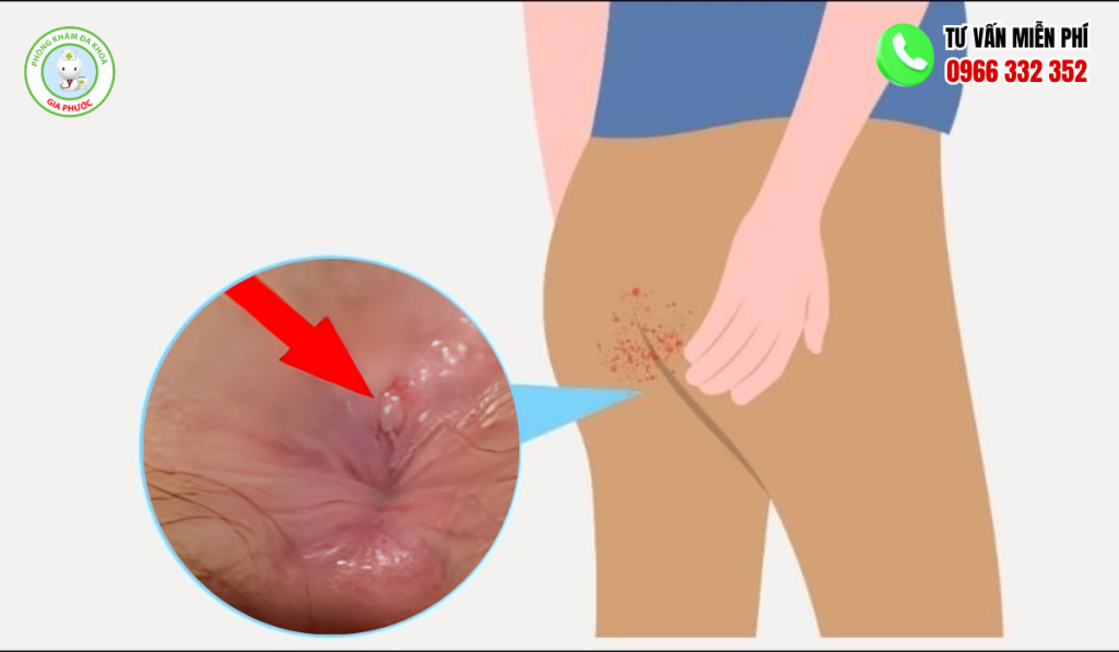 Nứt Kẻ Hậu Môn: Hình Ảnh, Cách Trị Hiệu Quả Chuẩn Y Khoa 4 Hình ảnh nứt kẽ hậu môn