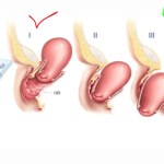 Hình ảnh sa tử cung độ 3