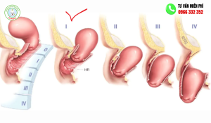 Hình ảnh sa tử cung độ 3
