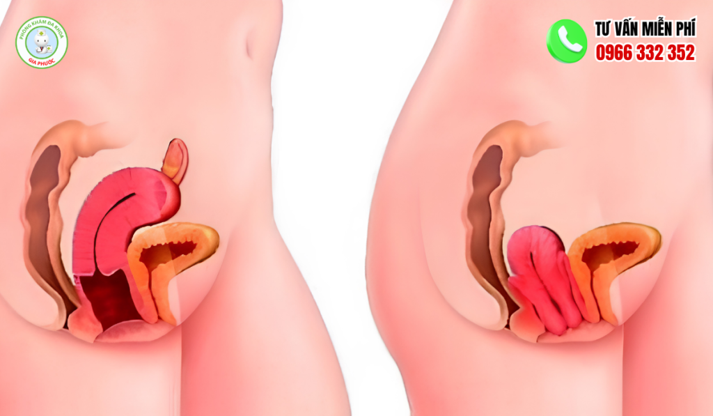 Hình Ảnh Sa Tử Cung Độ 3: Nhận Biết, Cách Trị Hiệu Quả 4 Hình ảnh sa tử cung độ 3