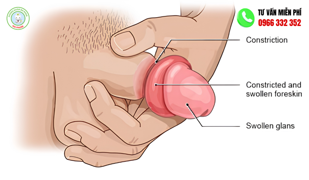 tổng quan bệnh Sưng bao quy đầu