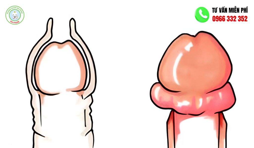 Sưng Bao Quy Đầu 