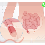 Hình Ảnh Thoát Vị Bẹn: Nhận Biết & Cách Điều Trị Hiệu Quả 12 Hình ảnh thoát vị bẹn