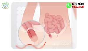 Hình ảnh thoát vị bẹn