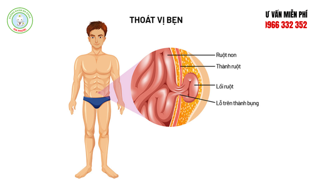 Hình Ảnh Thoát Vị Bẹn: Nhận Biết & Cách Điều Trị Dứt Điểm 2 Hình ảnh thoát vị bẹn