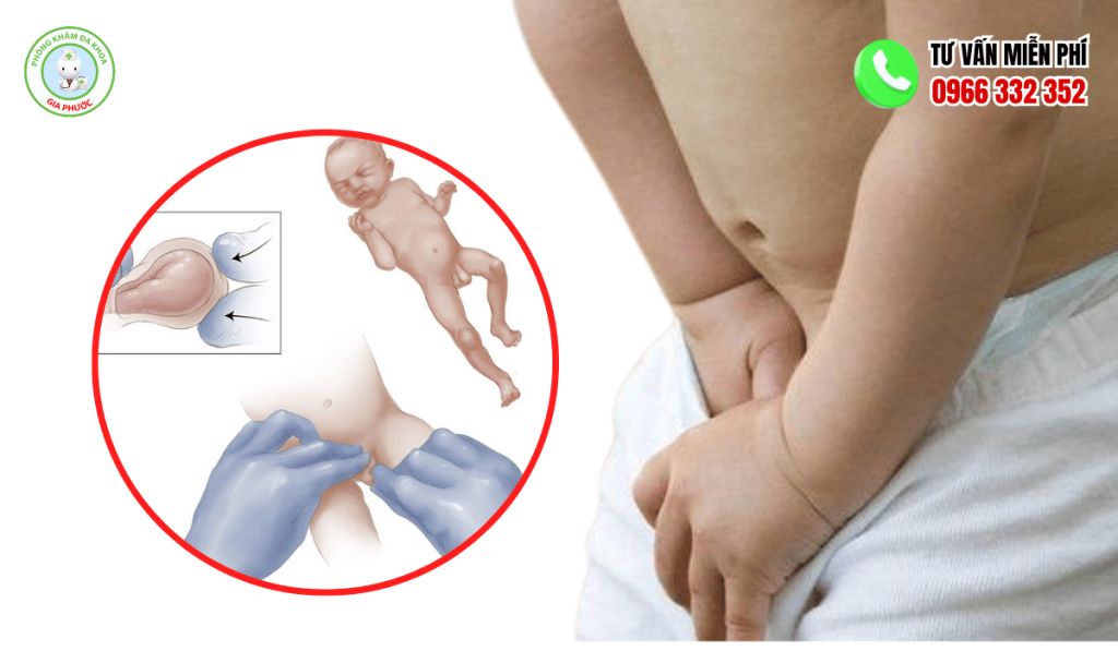 Hình Ảnh Thoát Vị Bẹn: Nhận Biết & Cách Điều Trị Dứt Điểm 4 Hình ảnh thoát vị bẹn