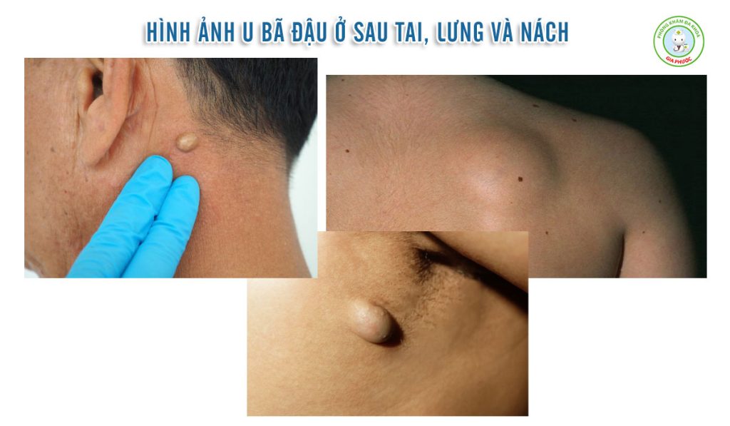 Hình ảnh u bã đậu ở sau tai, lưng và nách