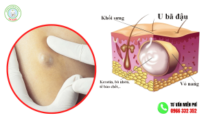 Hình ảnh u bã đậu