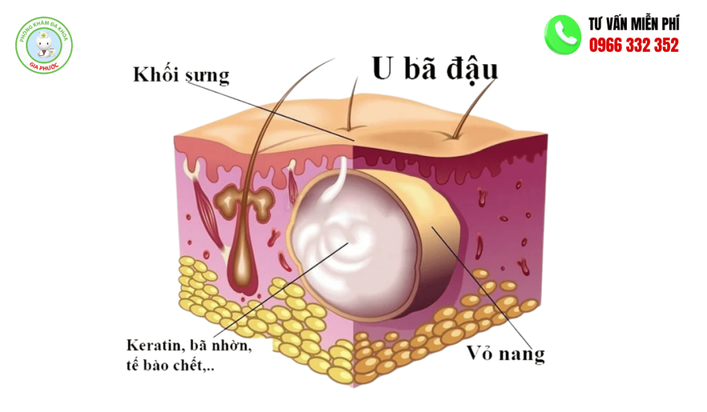 hinh anh u ba dau mo phong