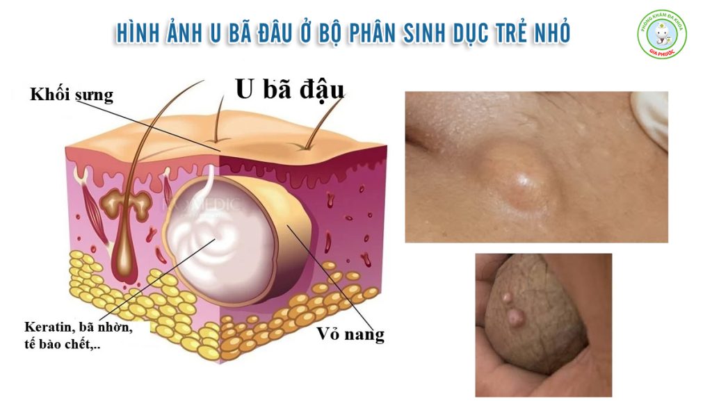 U Bã Đậu Ở Bộ Phận Sinh Dục Trẻ Nhỏ: Dấu Hiệu, Nguy Hiểm & Cách Xử Lý An Toàn 2 Hình ảnh u bã đậu ở bộ phận sinh dục trẻ nhỏ