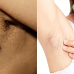 Hình ảnh u bã đậu ở nách