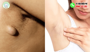 Hình ảnh u bã đậu ở nách