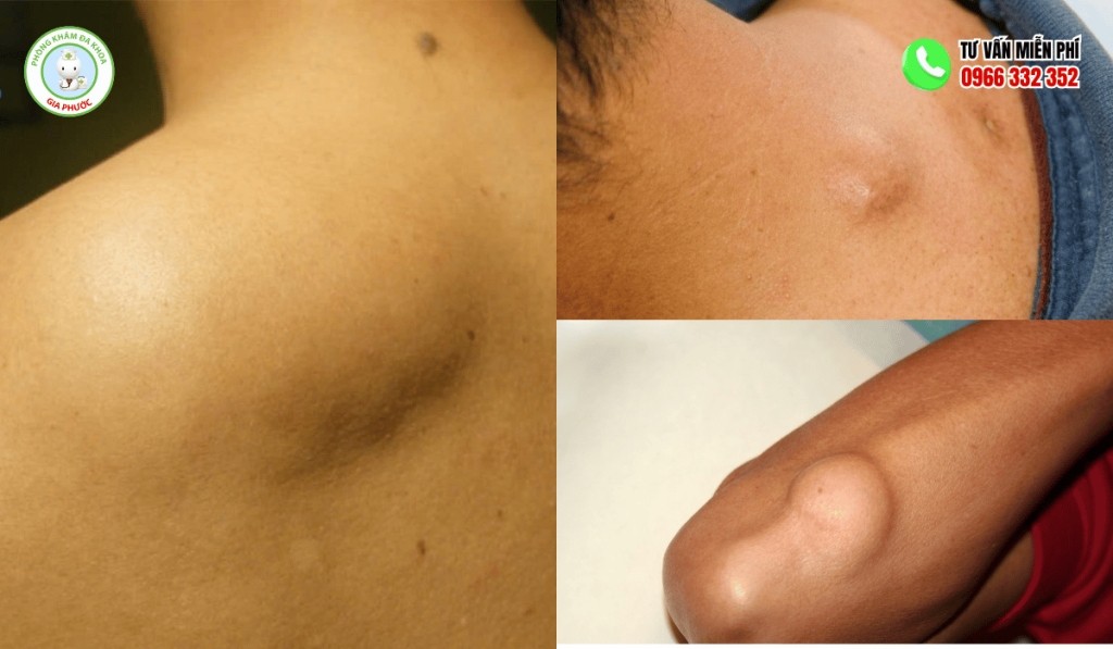 Hình Ảnh U Mỡ Chi Tiết Các Vị Trí Và Phương Pháp Điều Trị 3 Hình ảnh u mỡ
