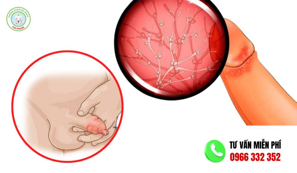 Hình Ảnh Bao Quy Đầu Bình Thường: Dài, Hẹp, Viêm Ở Người Lớn 4 Hình Ảnh Bao Quy Đầu Bình Thường: Dài, Hẹp, Viêm Ở Người Lớn