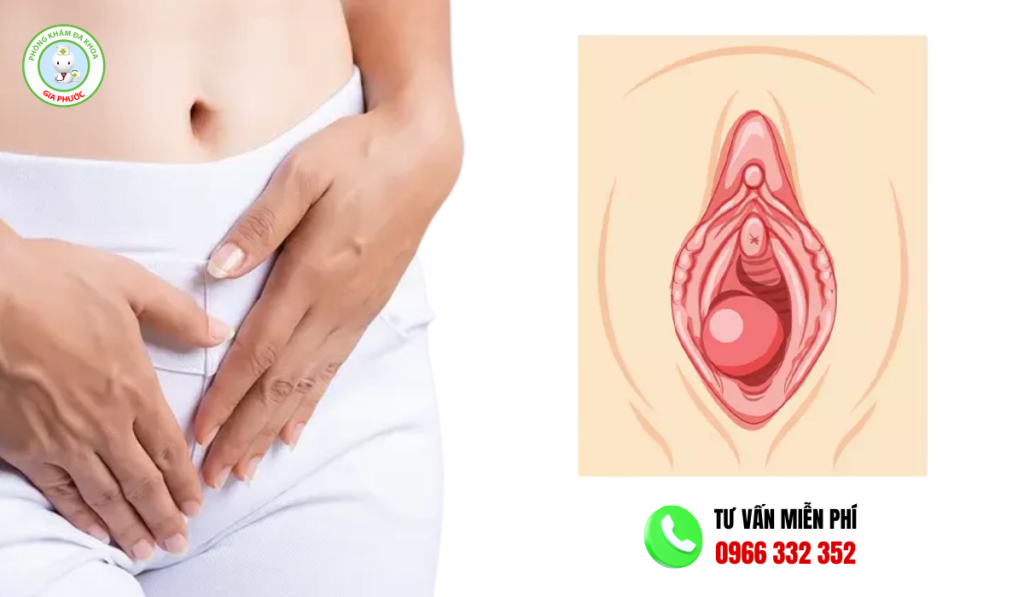 Hình Ảnh Viêm Tuyến Bartholin: Các Giai Đoạn & Cách Điều Trị 2 Hình ảnh viêm tuyến bartholin