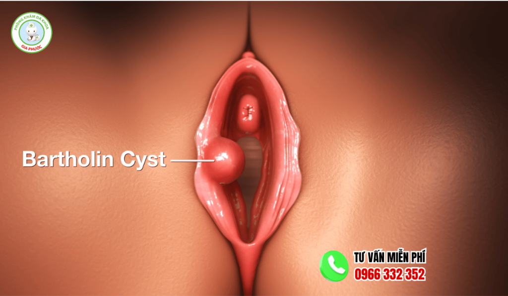Hình Ảnh Viêm Tuyến Bartholin: Các Giai Đoạn & Cách Điều Trị 4 Hình ảnh viêm tuyến bartholin theo giai đoạn