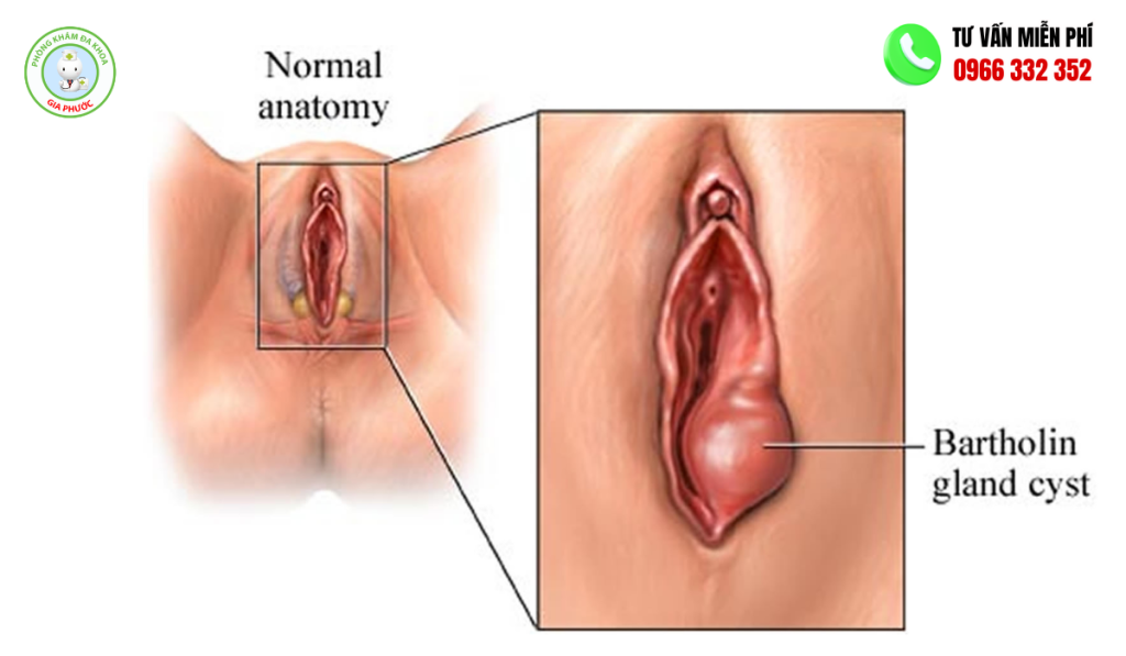 Hình Ảnh Viêm Tuyến Bartholin: Các Giai Đoạn & Cách Điều Trị 3 Hình ảnh viêm tuyến bartholin