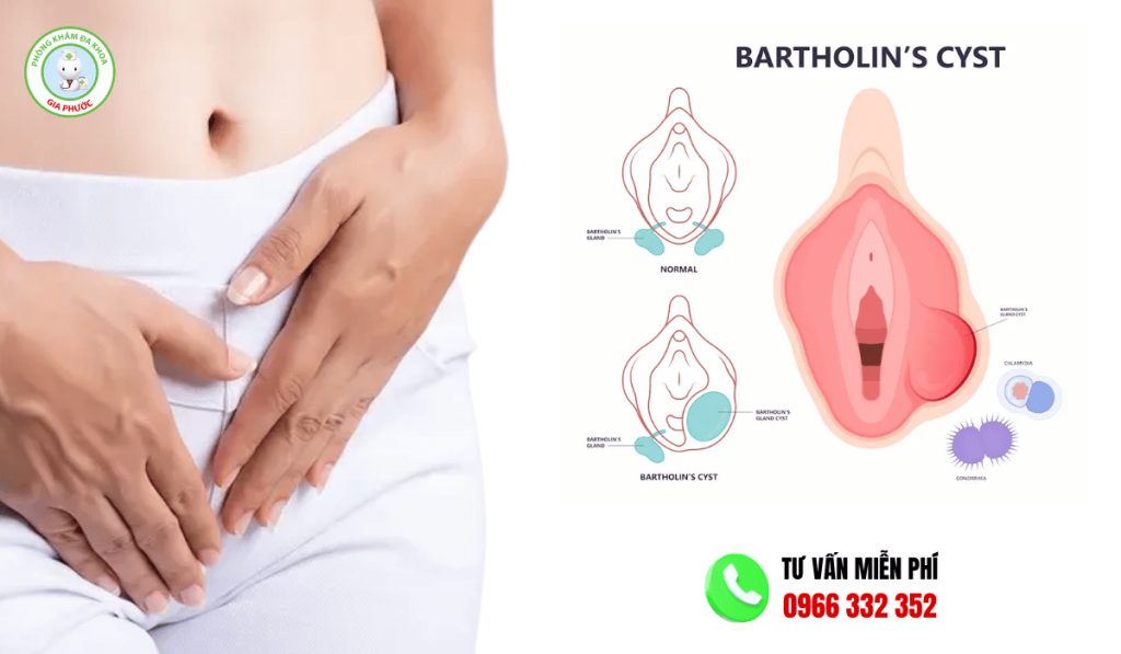 Hình Ảnh Viêm Tuyến Bartholin: Các Giai Đoạn & Cách Điều Trị 5 Hình ảnh viêm tuyến bartholin theo giai đoạn