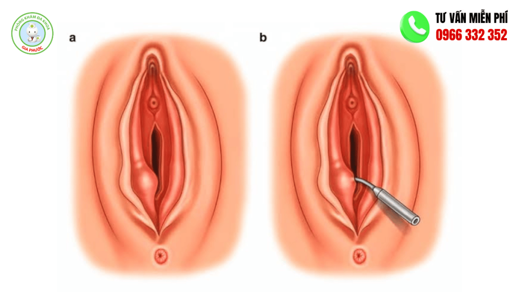 Hình Ảnh Viêm Tuyến Bartholin: Các Giai Đoạn & Cách Điều Trị 1 Hình ảnh viêm tuyến bartholin và cách điều trị