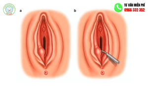 Hình ảnh viêm tuyến bartholin và cách điều trị