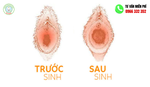 Hình ảnh vùng kín sau sinh thường