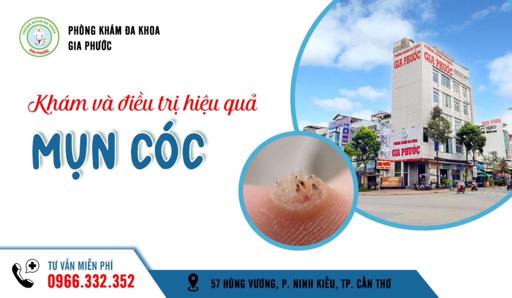 Phòng khám đa khoa Gia Phước - Khám và điều trị mụn cóc ở Cần Thơ