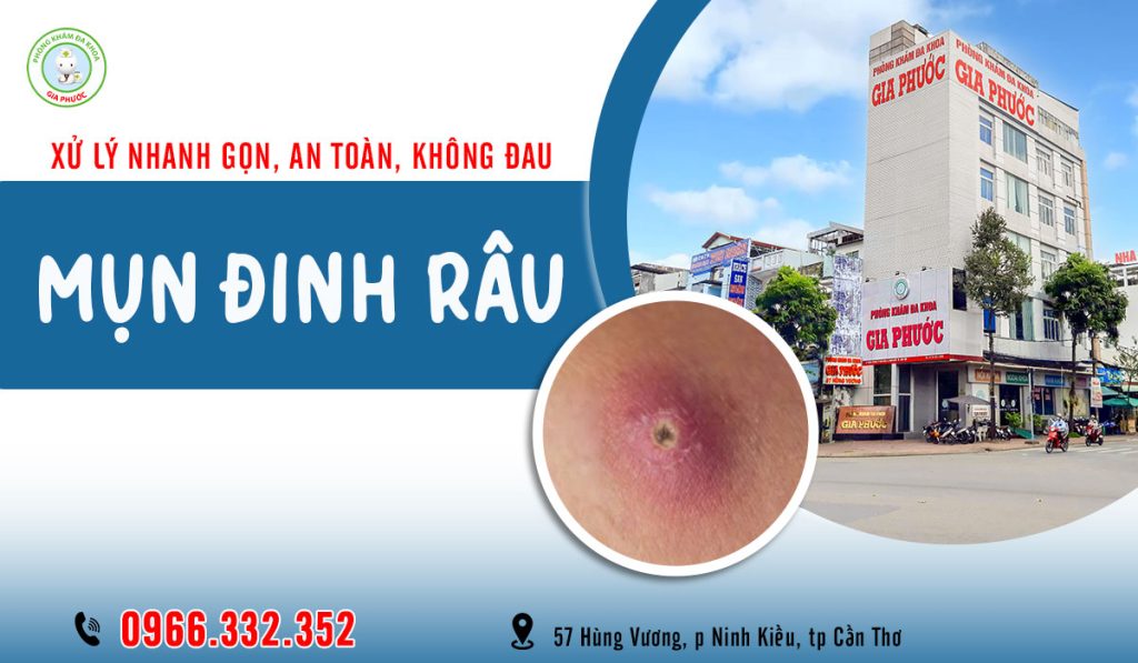 khám & chữa mụn đinh râu ở cần thơ