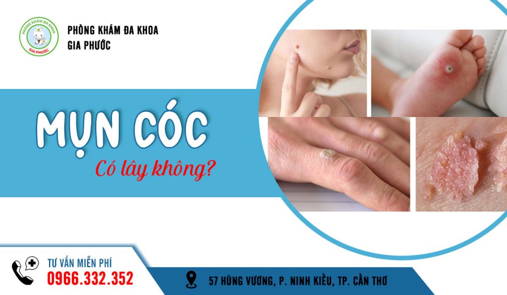 Mụn cóc có lây không?