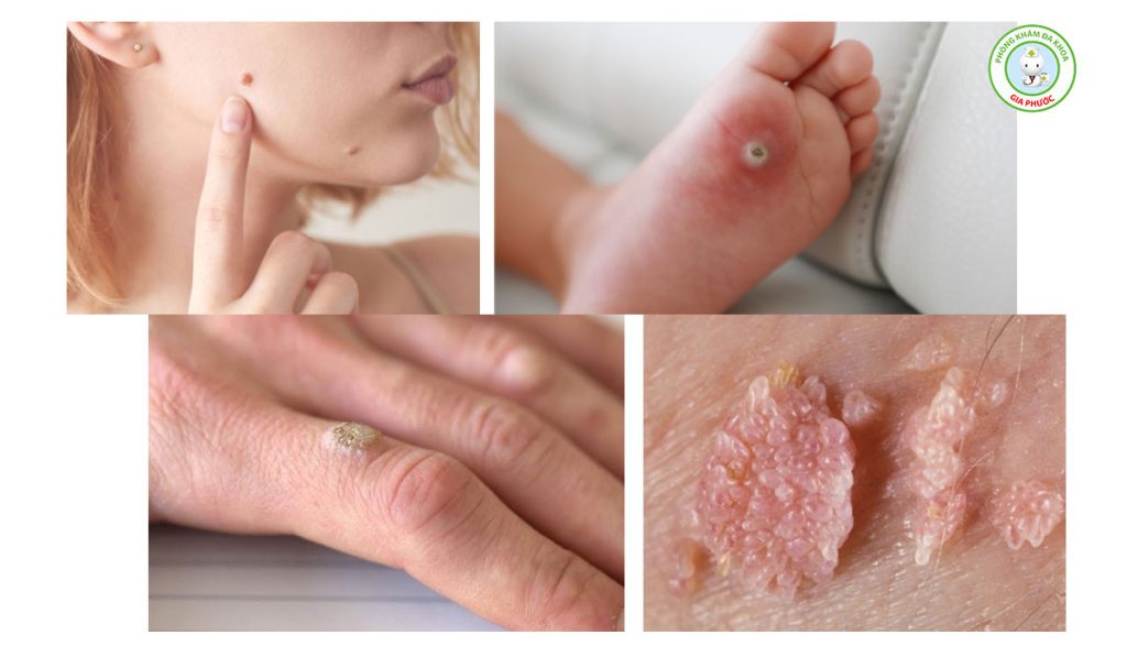 Các vị trí mọc mụn cóc trên cơ thể