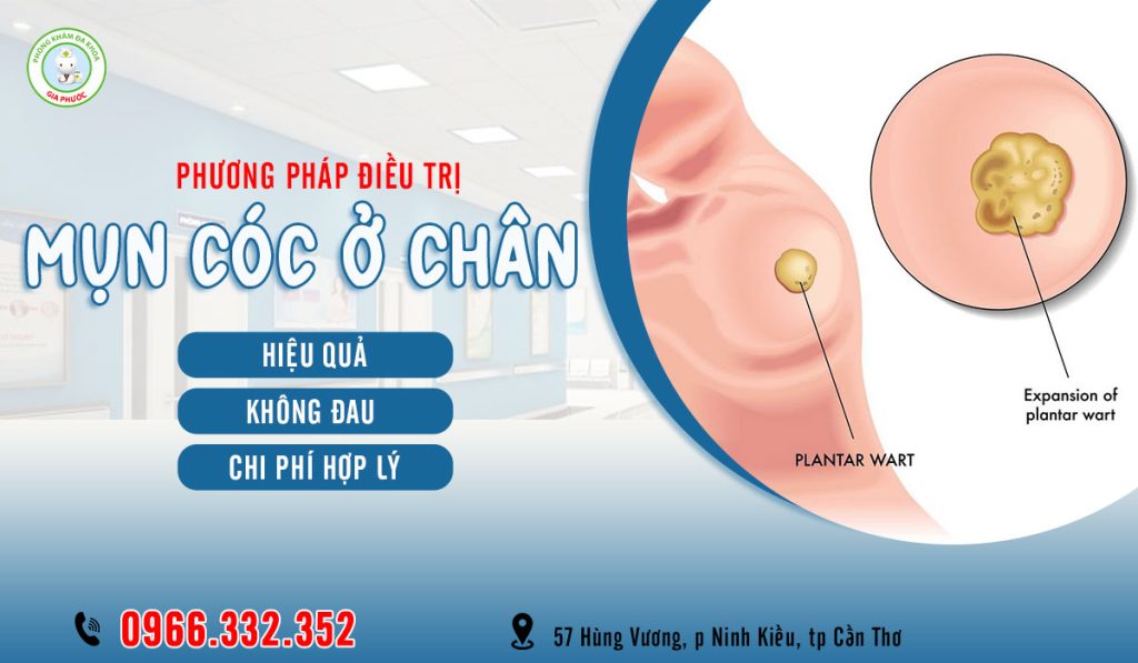 Mụn cóc ở chân có lây không? Cách điều trị mụn cóc ở chân