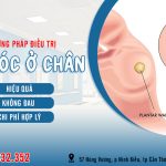 Mụn cóc ở chân có lây không? Cách điều trị mụn cóc ở chân