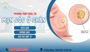 Mụn cóc ở chân có lây không? Cách điều trị mụn cóc ở chân