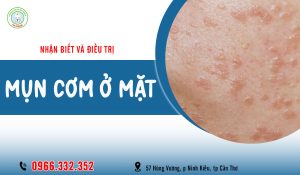 Mụn cơm ở mặt là gì? Nguyên nhân và cách trị mụn cơm ở mặt