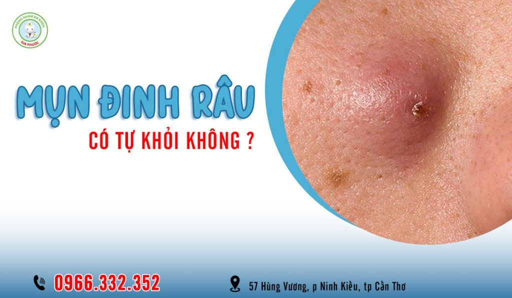 Mụn đinh râu có tự khỏi không?
