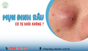 Mụn đinh râu có tự khỏi không?