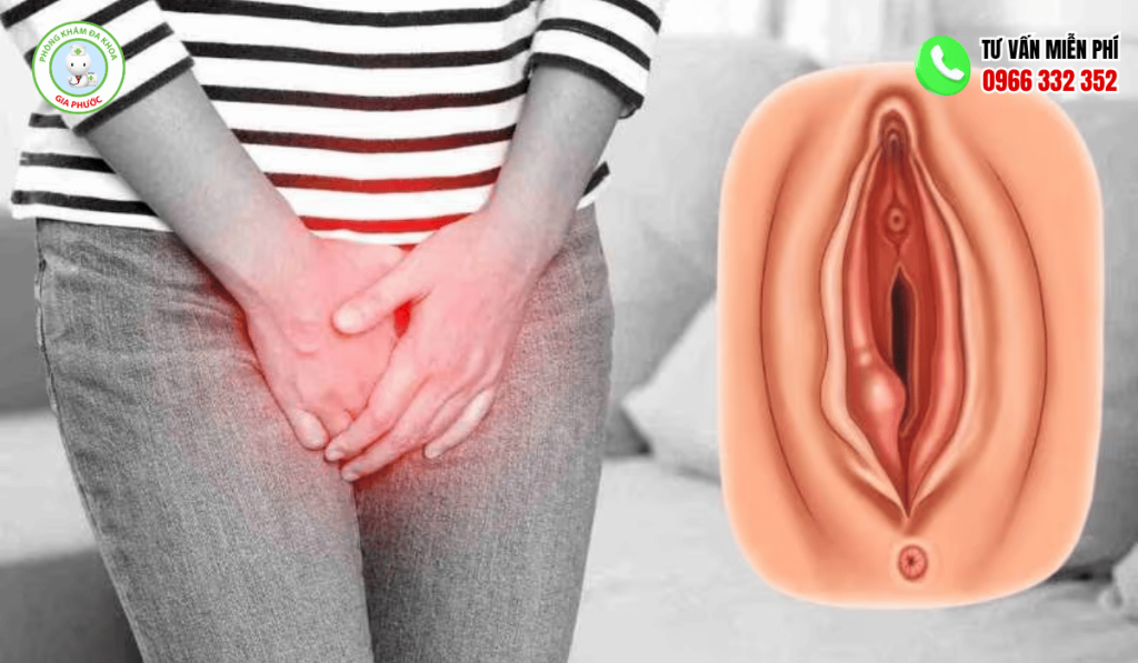 Viêm Tuyến Bartholin: Dấu Hiệu, Nguyên Nhân, Cách Điều Trị 3 Nguyên nhân viêm tuyến bartholin
