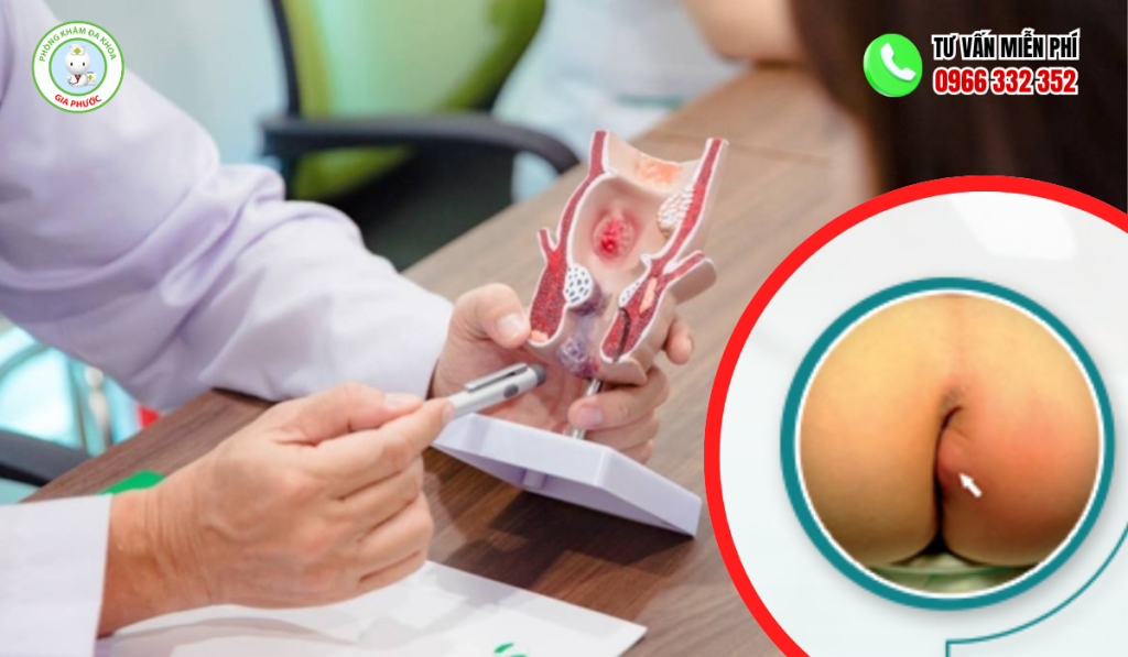 Áp Xe Hậu Môn Ở Trẻ Sơ Sinh: Dấu Hiệu, Nguyên Nhân & Cách Chữa Trị 2 Nguyên nhân áp xe hậu môn