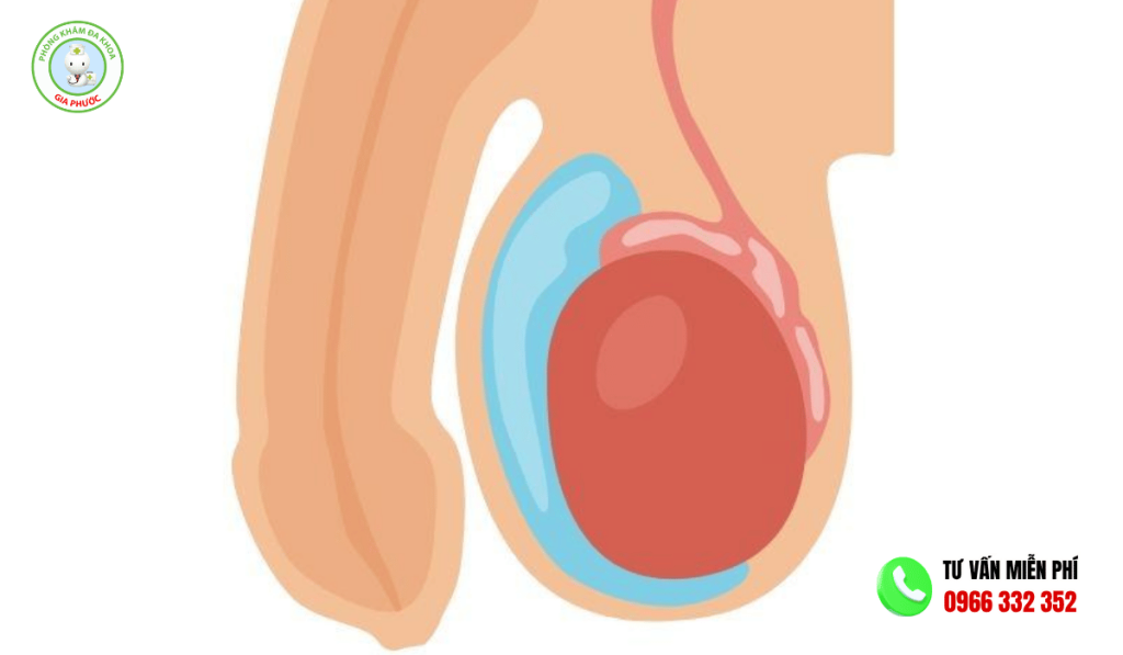 Đau Tinh Hoàn Bên Phải: Dấu Hiệu Cảnh Báo, Nguyên Nhân & Cách Điều Trị 2 Nguyên nhân gây đau tinh hoàn bên phải