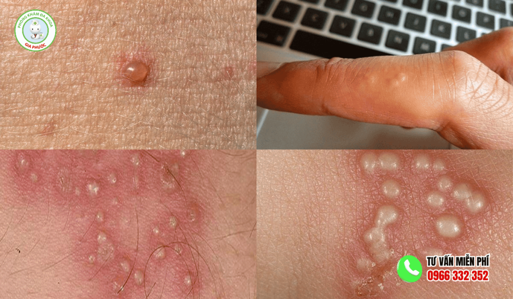 Nguyên nhân gây nổi mụn nước